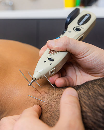 Dry-needling-and-physiotherapist-Dubai