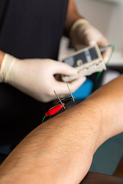 Dry-needling-physiotherapist-Dubai
